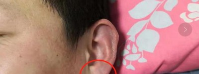 耳相：耳骨反耳朵有缺口，耳垂有横纹有什么说法